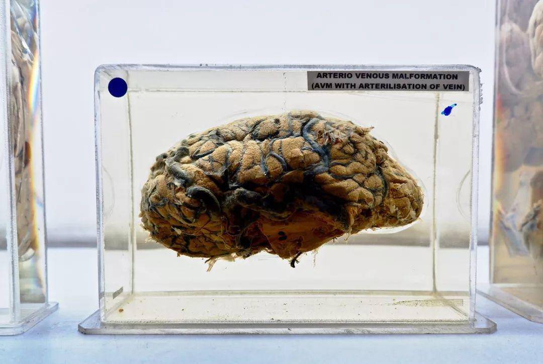 脑囊虫病及其他：欢迎来到印度器官博物馆