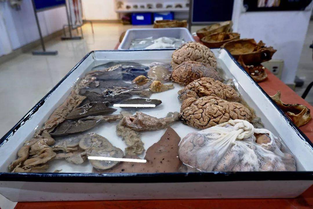 脑囊虫病及其他：欢迎来到印度器官博物馆